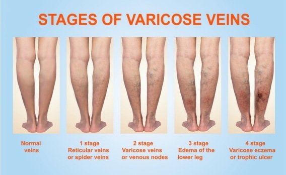 Varicose Veins Treatment