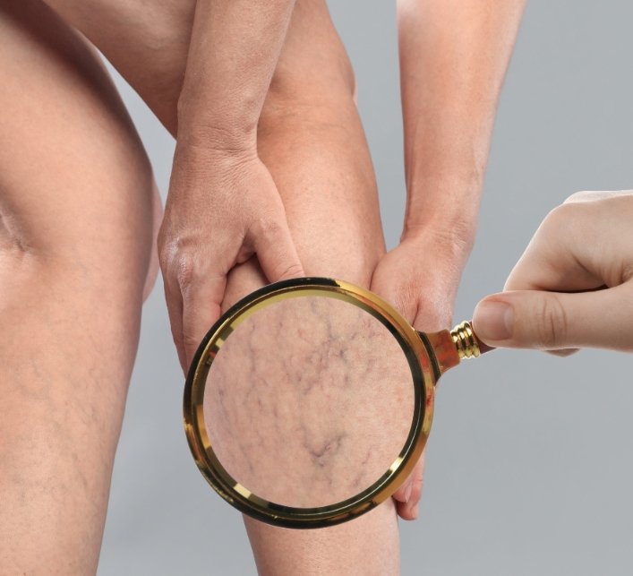 Varicose Veins specialist treatment at Pandey Diagnostics Center